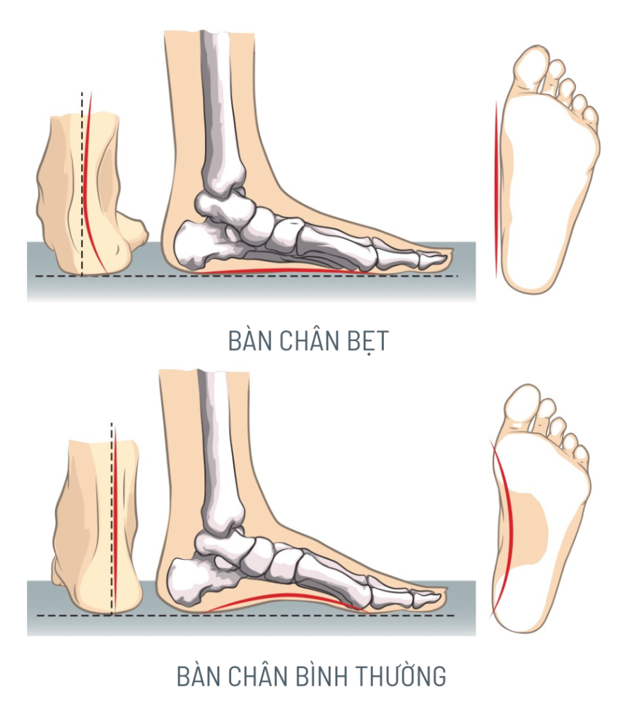 So sánh giữa bàn chân bẹt và bàn chân bình thường