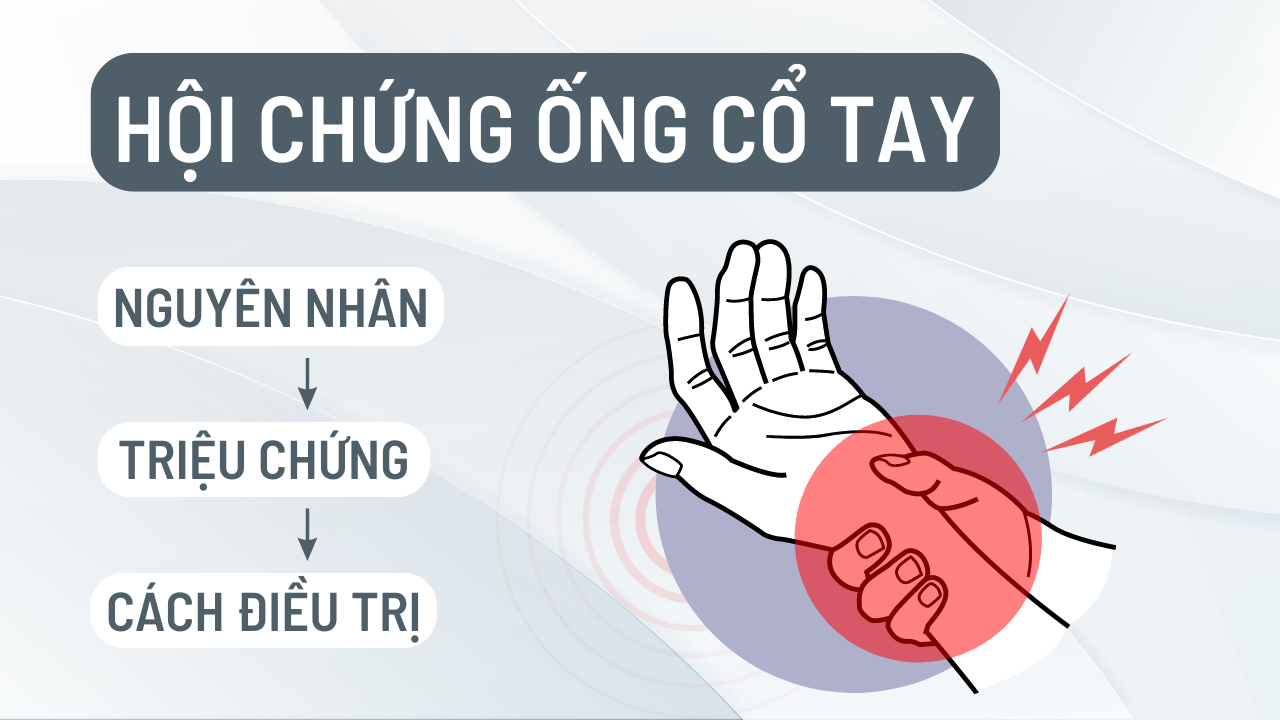 hội chứng ống cổ tay